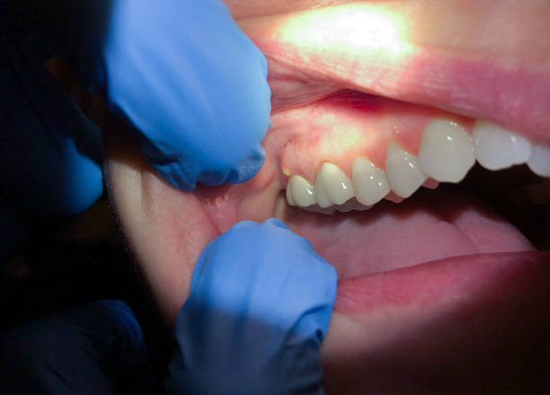 Best Dentist for Tooth Abscess  in Nesquehoning, PA